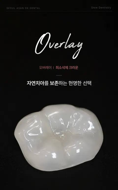 서울아산OK치과 원내 LED 화면 — 시술 브랜드 Overlay(최소삭제 크라운), 자연치아를 보존하는 현명한 선택