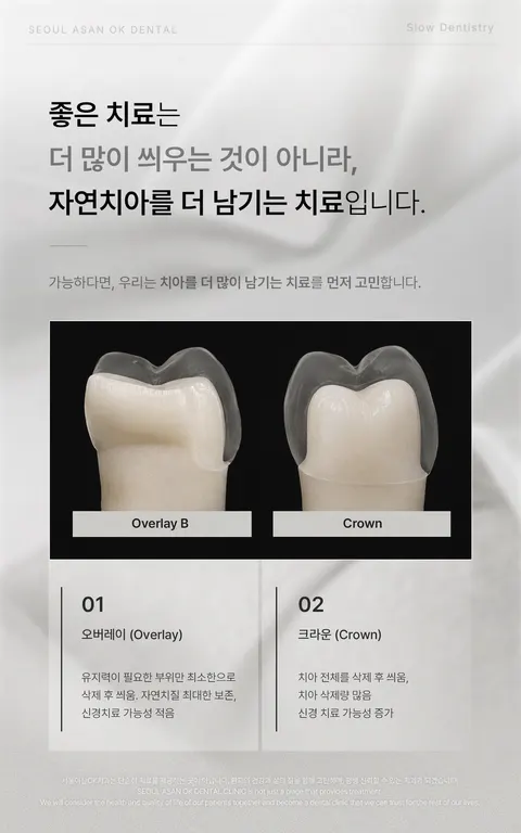 서울아산OK치과 원내 LED 화면 — 좋은 치료는 더 많이 씌우는 것이 아니라 자연치아를 더 남기는 치료, 오버레이와 크라운의 삭제량 비교